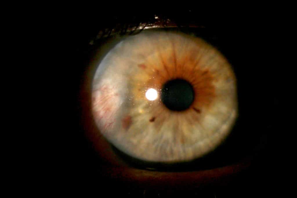 Bluterguss Im Auge Ursachen Und Gegenmassnahmen Heilpraxis