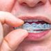 Patienten, bei denen nächtliches Zähneknirschen vorkommt, bekommen meistens eine Aufbissschiene zum Schutz ihrer Zähne. (Bild: stylefoto24/fotolia.com)