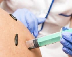 Anwendung einer Blutegeltherapie