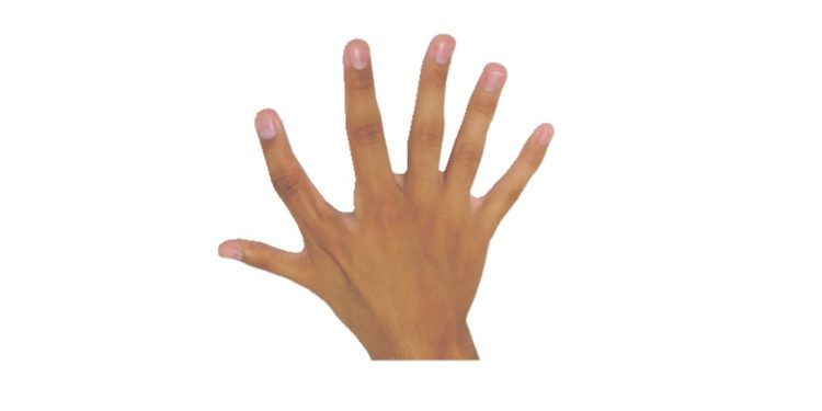 Eine Hand mit sechs Fingern