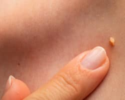 Finger zeigt auf Warze im Halsbereich