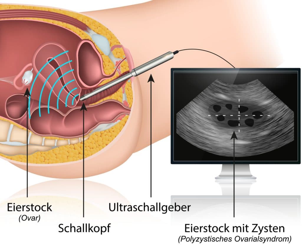 Vagialer Ultraschall und Polyzystisches Ovarialsyndrom
