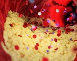 Blutfluss in Arterie mit Plaque