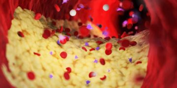 Blutfluss in Arterie mit Plaque