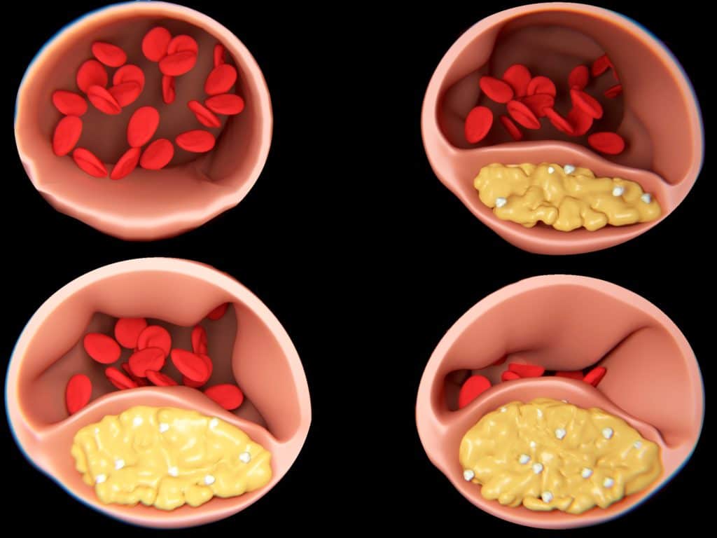 Querschnitte Arterie Bildung von Arteriosklerose