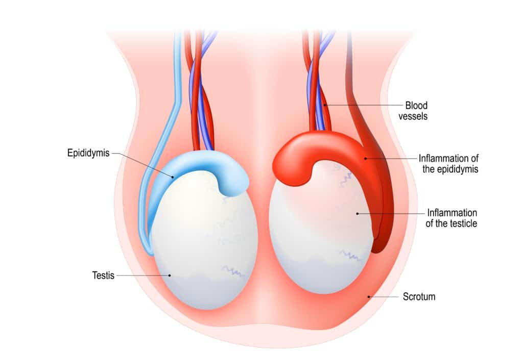 Krankheitsbild Nebenhodenentzündung