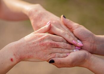 Neurodermitis auf den Handrücken einer Frau, die ihre beiden Hände in die Hände einer anderen Frau legt