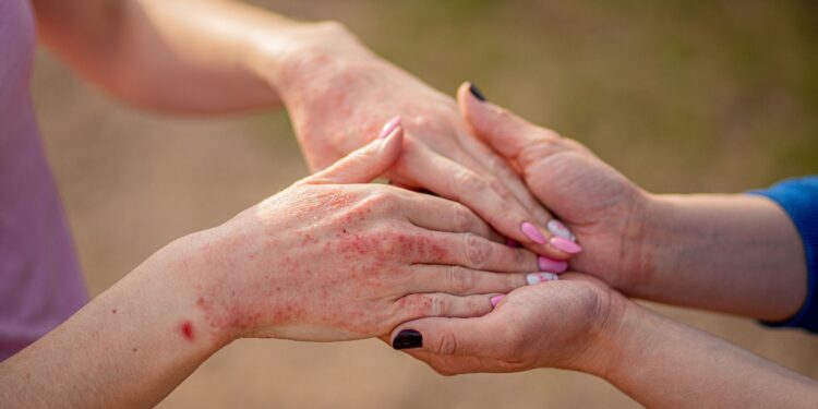 Neurodermitis auf den Handrücken einer Frau, die ihre beiden Hände in die Hände einer anderen Frau legt