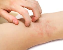 Hand kratzt an Ausschlag in der Armbeuge.