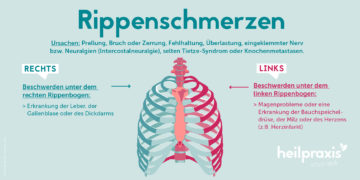 Schematische Darstellung der Rippen und möglicher Ursachen für Rippenschmerzen.