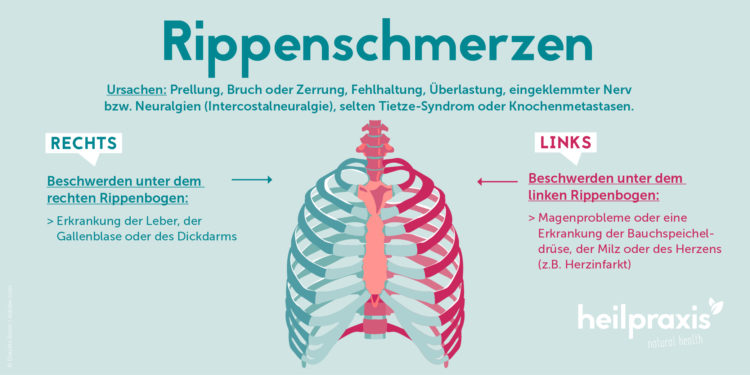 Schematische Darstellung der Rippen und möglicher Ursachen für Rippenschmerzen.