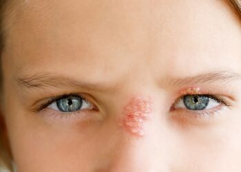 Mädchen mit Herpes am Auge und an der Nase.