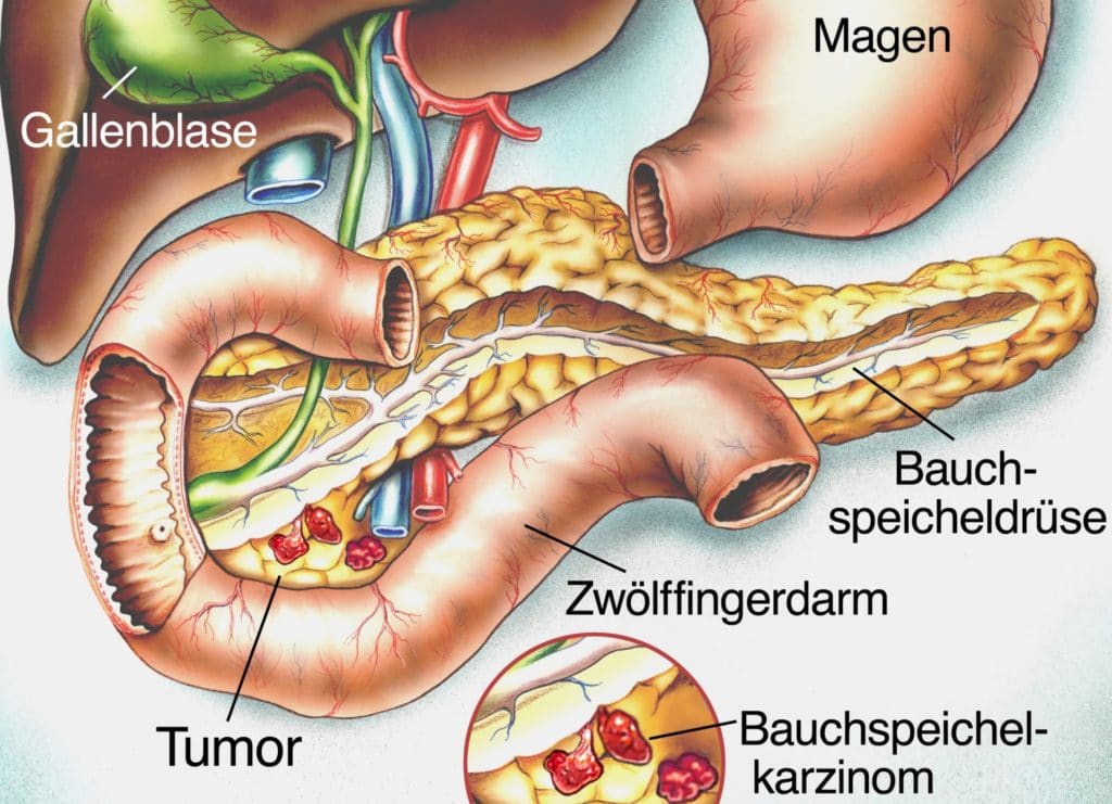 Anatomie Verdauungsorgane mit Pankreaskarzinom