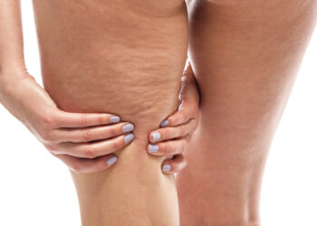 Auch in jungen Jahren zeigt sich bei vielen Frauen an den Oberschenkel Cellulite infolge eines schwächeren Bindegewebes. (Bild: Tanya Rozhnovskaya/stock.adobe.com)