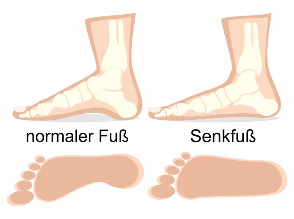 Vergleichende zeichnerische Darstellung eines normalen Fußes und eines Senkfußes.