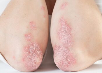 Akute Psoriasis an den Ellbogen