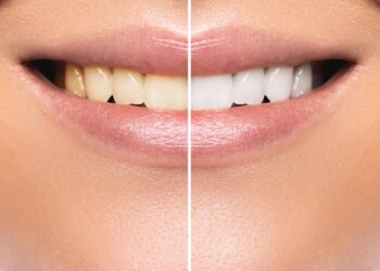 Lächelnder Mund einer Frau in Großaufnahme mit verfärbten Zähnen auf der linken Seite und mit weißen Zähnen auf der rechten Seite.