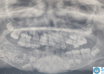 Gebiss-Röntgenbild zeigt deutlich zu viel Zähne.