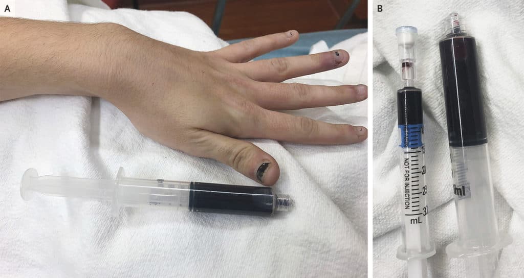 Verfärbte Fingernägel und entnommenes verfärbtes Blut einer Patientin mit Methämoglobinämie