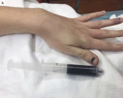 Verfärbte Fingernägel und entnommenes verfärbtes Blut einer Patientin mit Methämoglobinämie