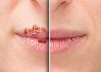 In der Mitte geteilte Großaufnahme eines Mundes mit links Herpes und recht ohne Herpes.