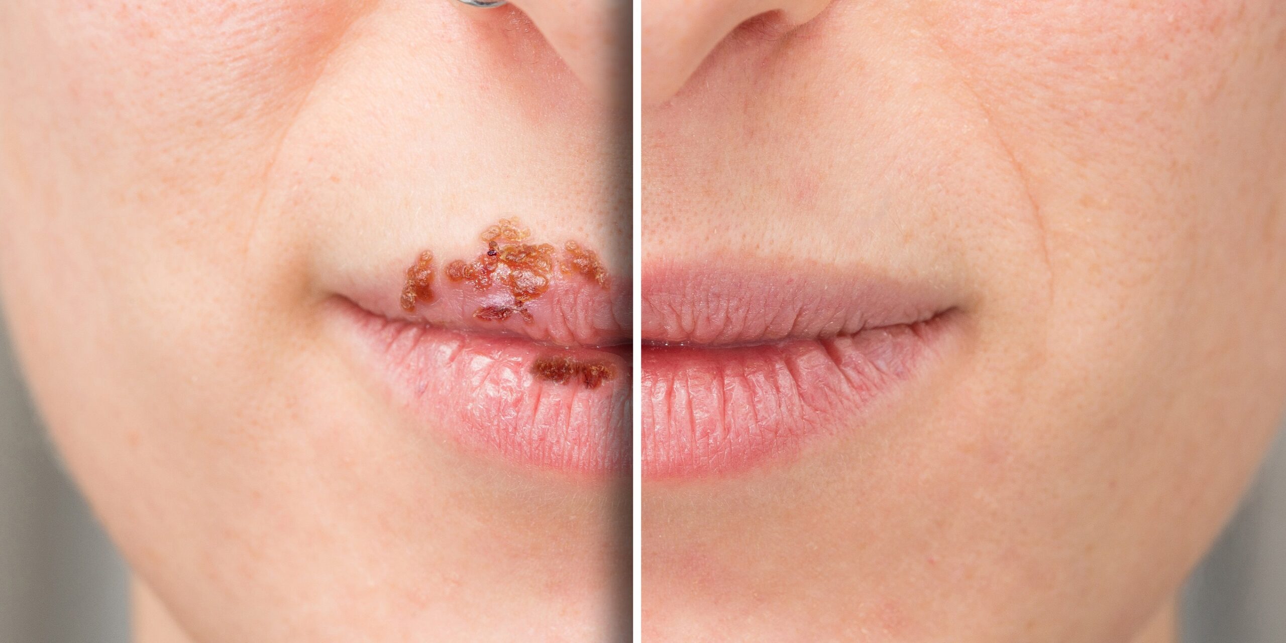 Herpes im Mund – Auslöser und Behandlung – Heilpraxis