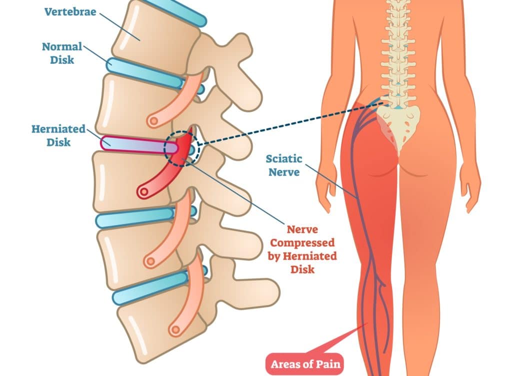 Schematische Zeichnung Bandscheibenvorfall mit Folge Ischiasschmerzen