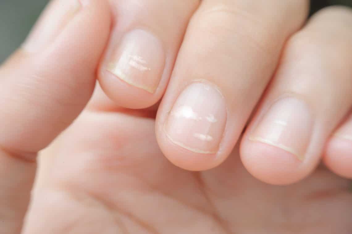 Weisse Flecken Auf Den Fingernageln Heilpraxis