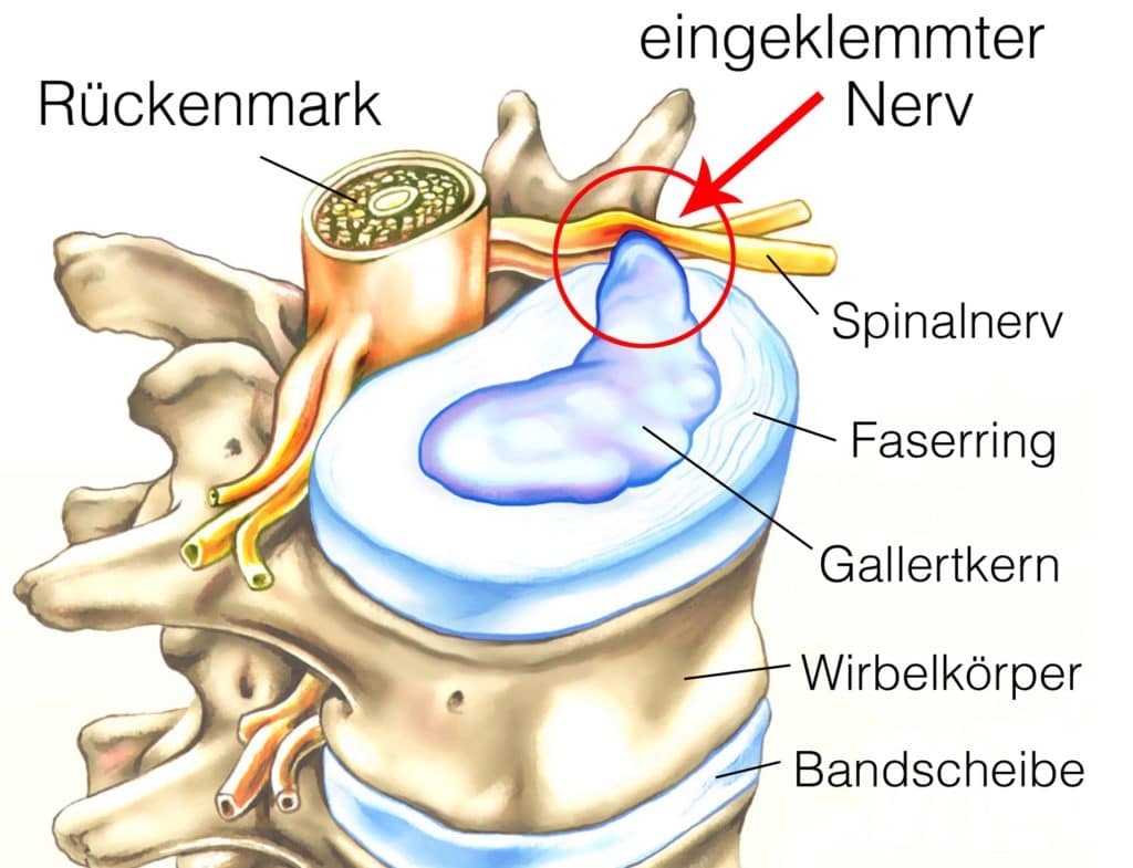 Schematische Darstellung Bandscheibenvorfall