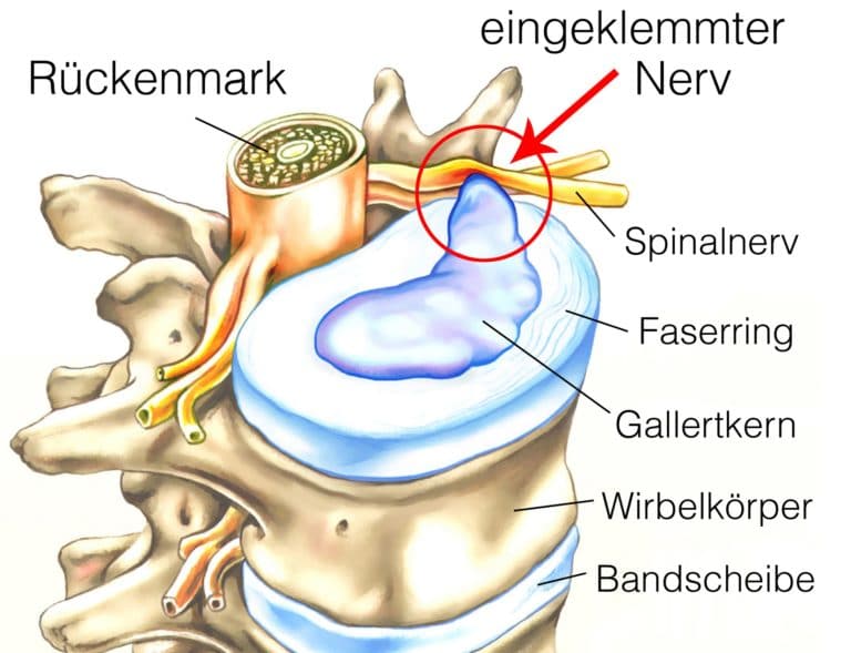 Nerv Im Brustkorb Eingeklemmt Symptome www.heilpraxisnet.de