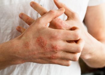 Eine Person mit Hautausschlag an den Händen kratzt sich am Handrücken.
