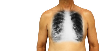 Eine Röntgenaufnahme der Lunge eines Mannes mit COPD.