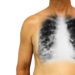 Eine Röntgenaufnahme der Lunge eines Mannes mit COPD.