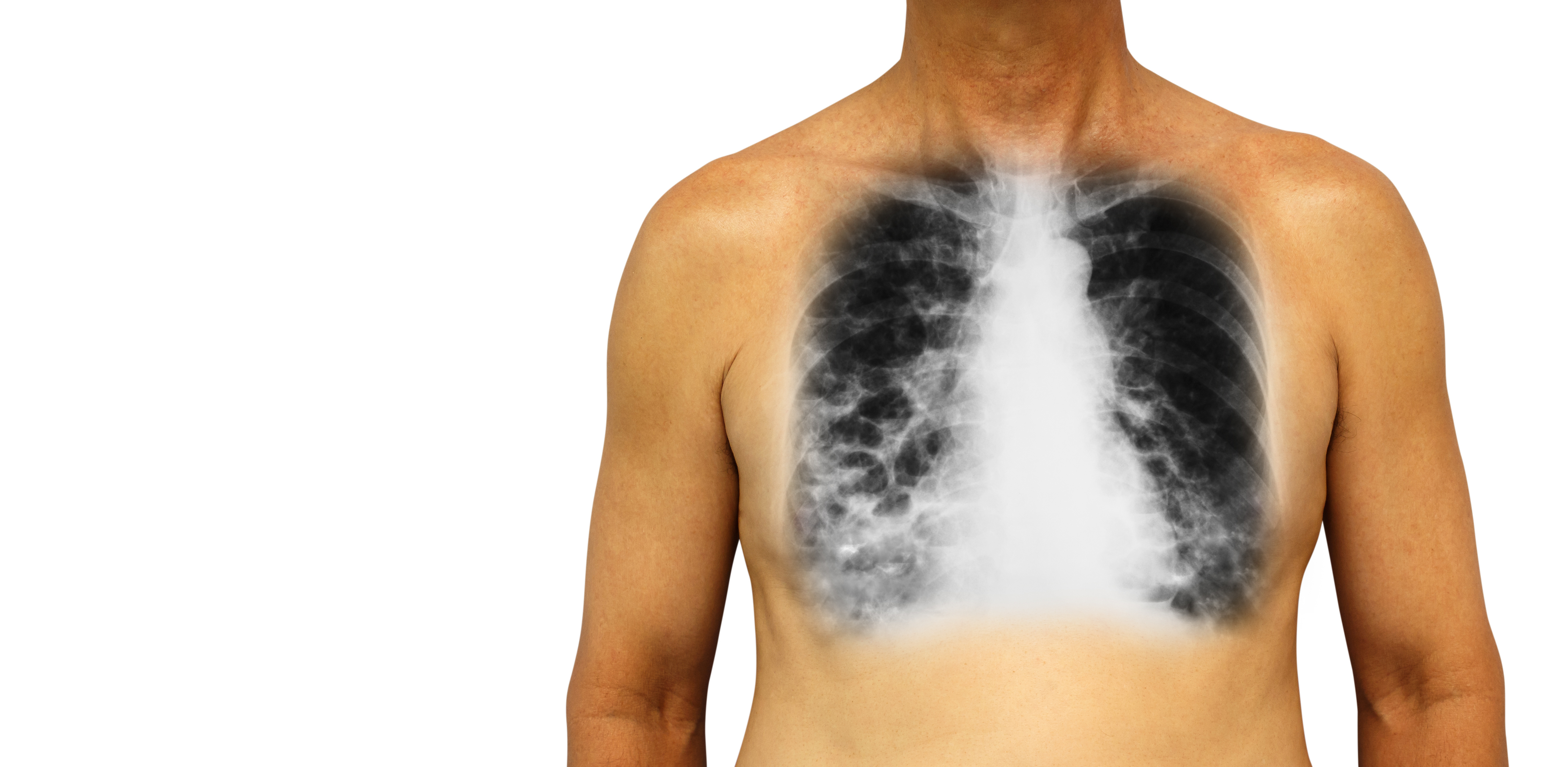 COPD im Frühstadium durch neues Diagnoseverfahren erkennen – Heilpraxis