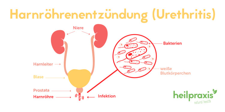 Abbildung des männlichen Harnsystems mit Darstellung einer Entzündung in der Harnröhre neben einer vergrößerten Darstellung von bakteriellen Krankheitserregern.
