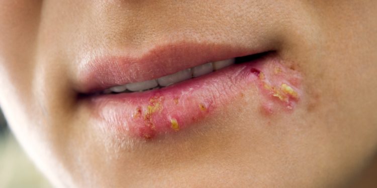 Lippen einer Frau mit Lippenherpes.