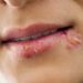 Lippen einer Frau mit Lippenherpes.