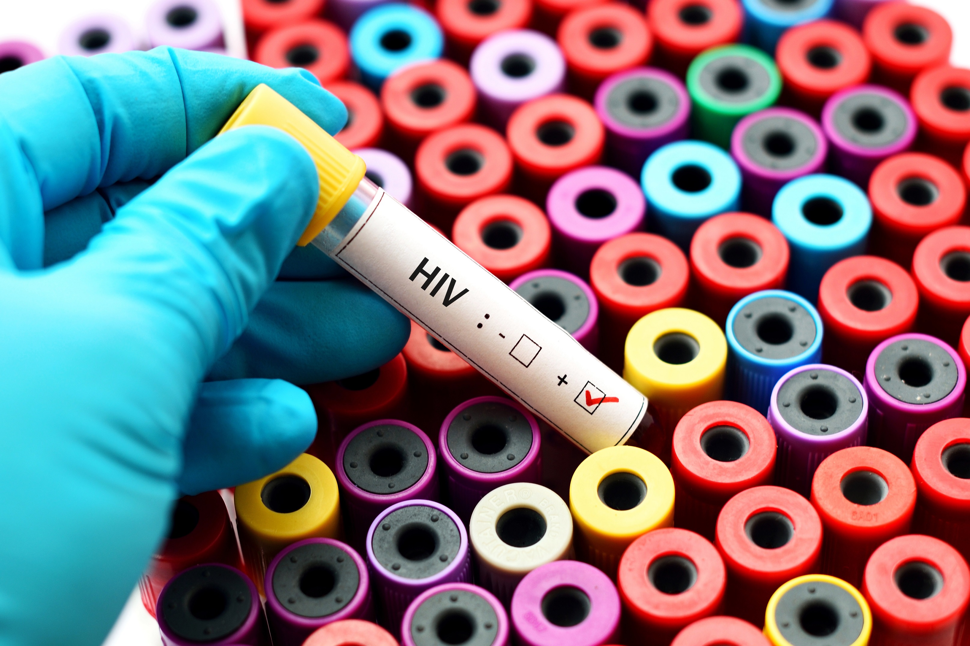 Neuer Hiv Stamm Entdeckt Erhohte Aids Gefahr Naturheilkunde