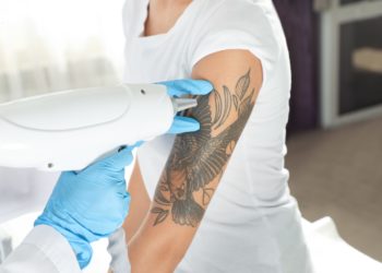 Frau unterzieht sich einer Tattoo-Entfernung per Laser