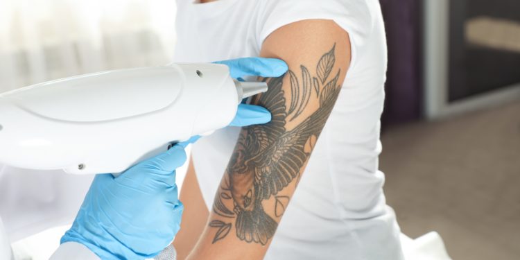 Frau unterzieht sich einer Tattoo-Entfernung per Laser