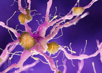 Eine grafische Darstellung von Amyloid-Ablagerungen im Gehirn.