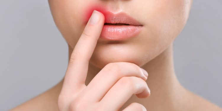 Frau mit Herpes-Fieberbläschen an den Lippen