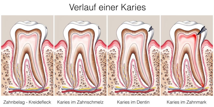 Verlauf einer Karies in 4 Stufen