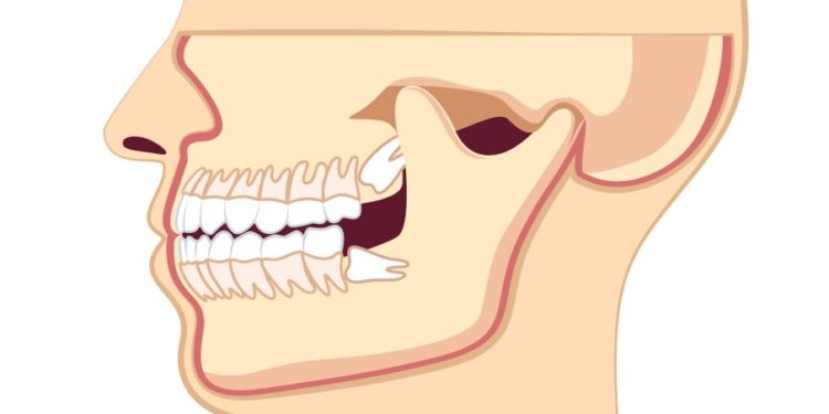 Zahn ziehen nach kieferknochenentzündung schmerzen nach