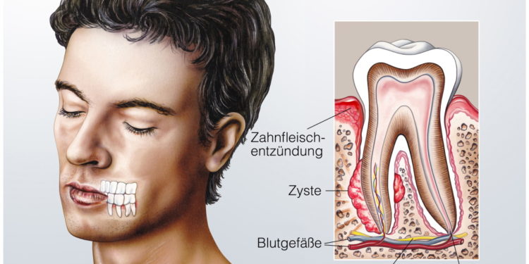 Zyste im Kiefer