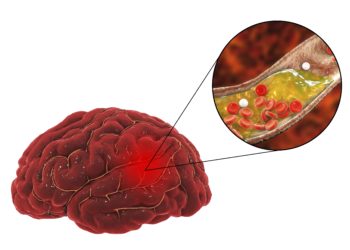 Grafische Darstellung eines menschlichen Gehirn, in dem eine Arterie verstopft ist.