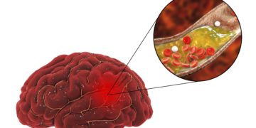 Grafische Darstellung eines menschlichen Gehirn, in dem eine Arterie verstopft ist.