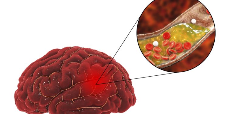 Grafische Darstellung eines menschlichen Gehirn, in dem eine Arterie verstopft ist.