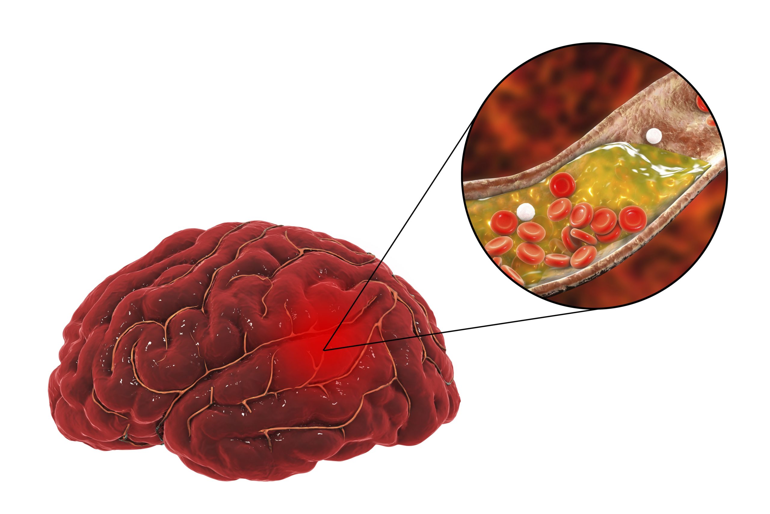 Schlaganfall Blut oder Speichelprobe zeigt das Risiko Heilpraxis Schlaganfall Blut oder Speichelprobe zeigt das Risiko Heilpraxis