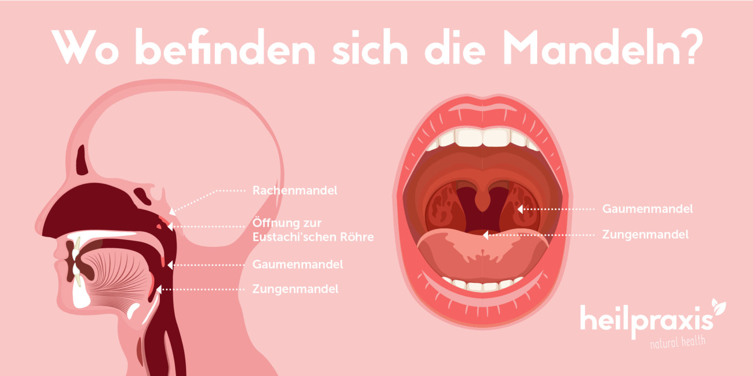 Rödern (Roederbehandlung) Entfernung der Mandelsteine Heilpraxis